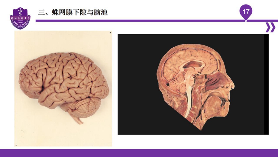 004脑室、脑膜、脑池、脑脊液_19.jpg