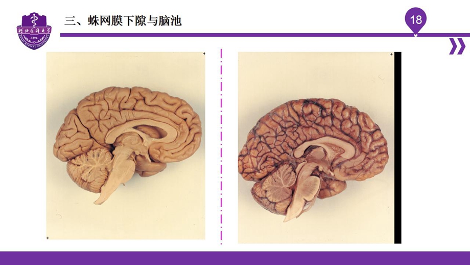 004脑室、脑膜、脑池、脑脊液_20.jpg